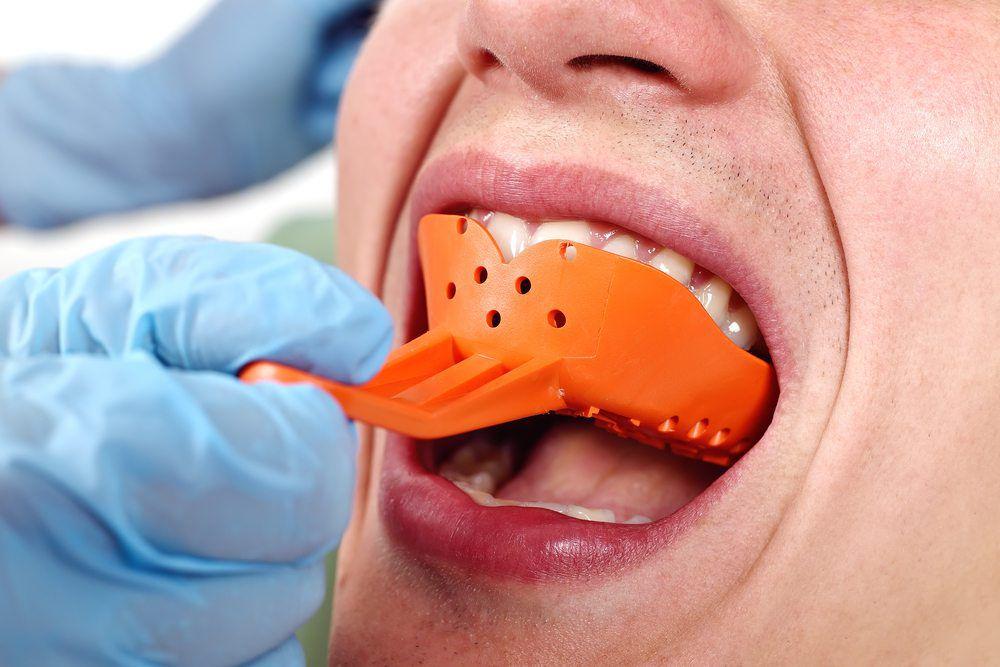 Mouthpiece Guy Mouthguard Fitting Process